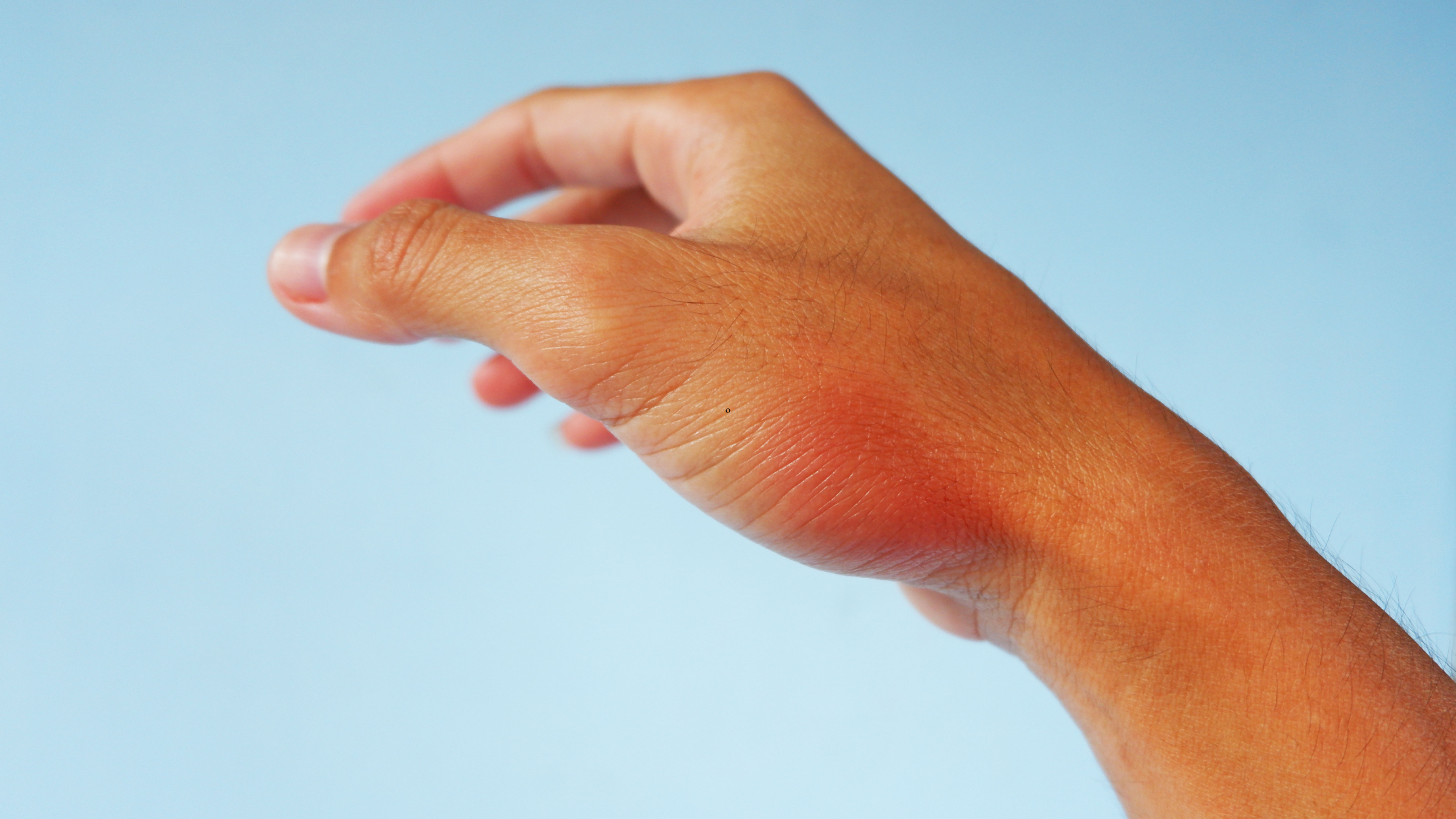 thumb osteoarthritis