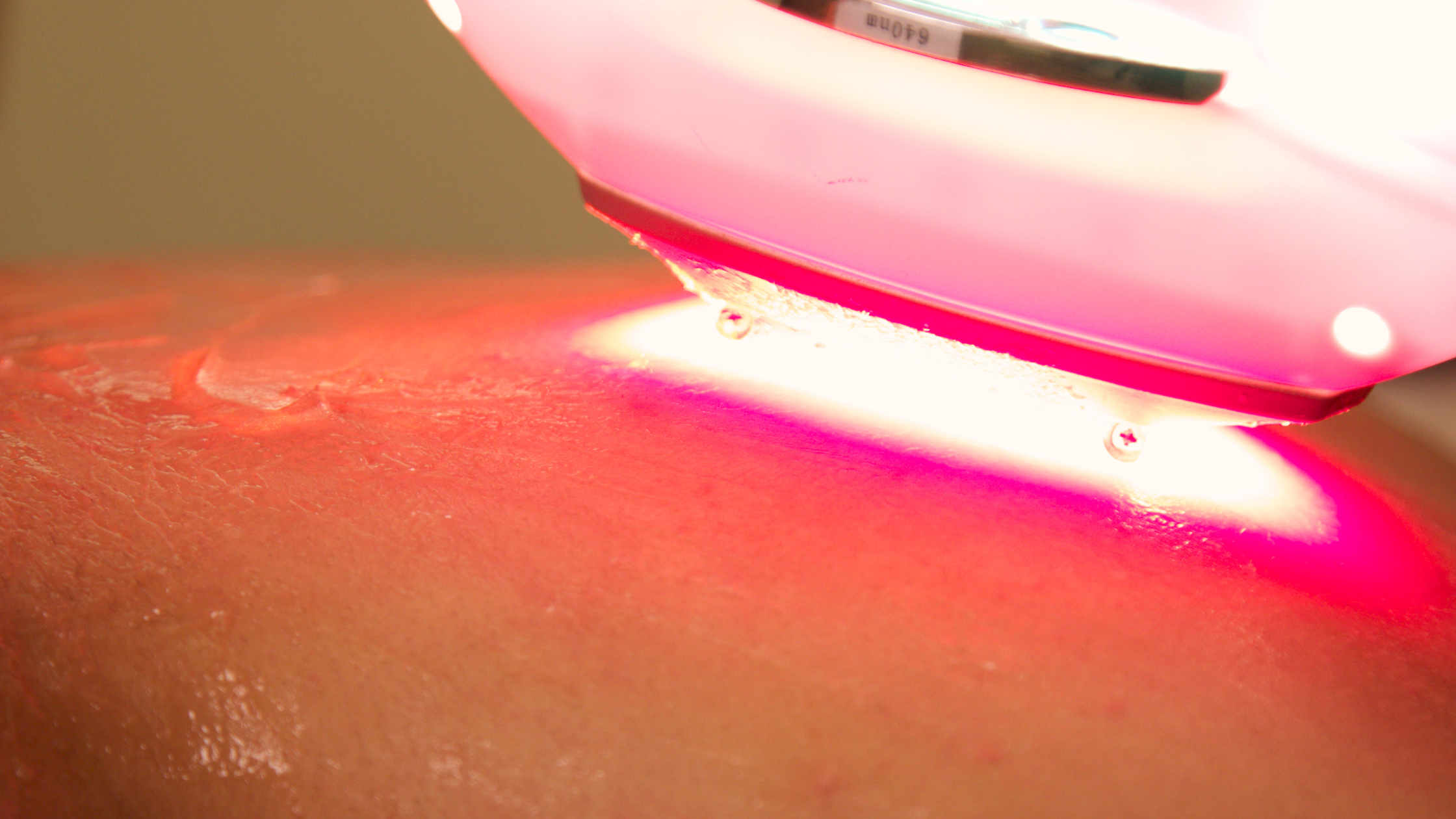 MLS laser therapy